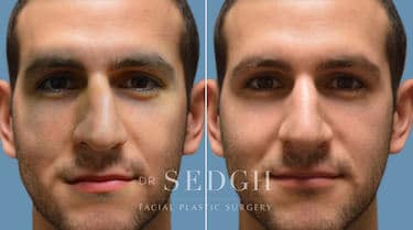 Nasal Fracture Before and After | Sedgh