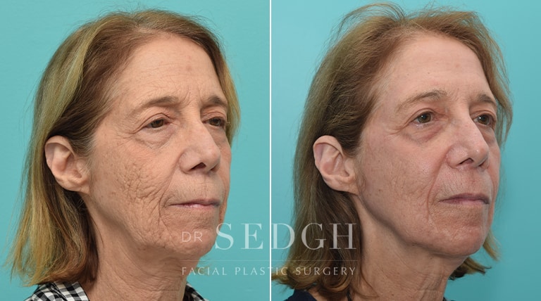 Laser Skin Treatments Before and After | Sedgh