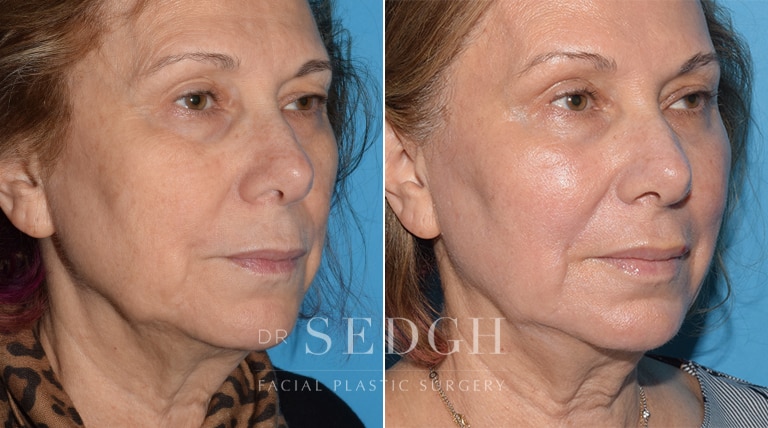 Laser Skin Treatments Before and After | Sedgh