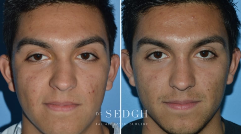 Nasal Fracture Before and After | Sedgh