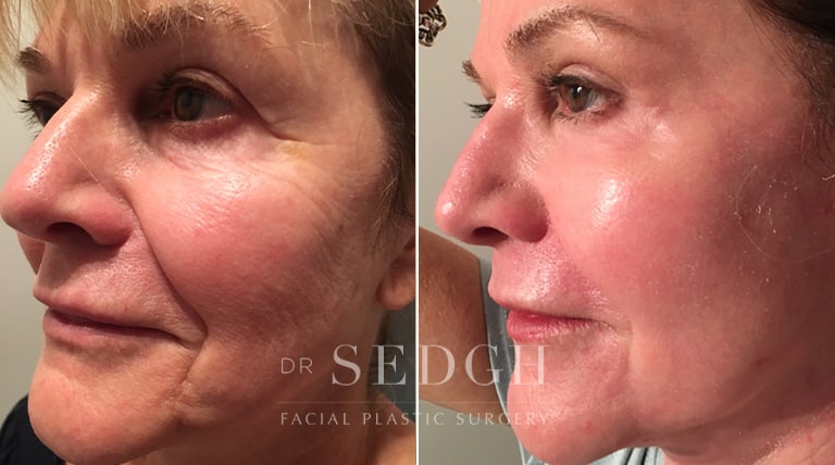 Laser Skin Treatments Before and After | Sedgh