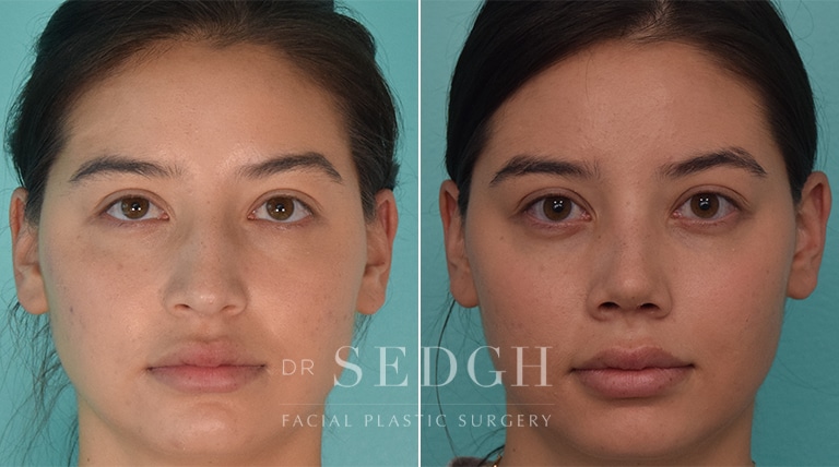 Female Rhinoplasty Before and After | Sedgh