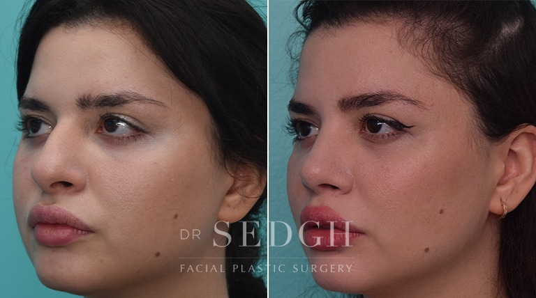 Female Rhinoplasty Before and After | Sedgh