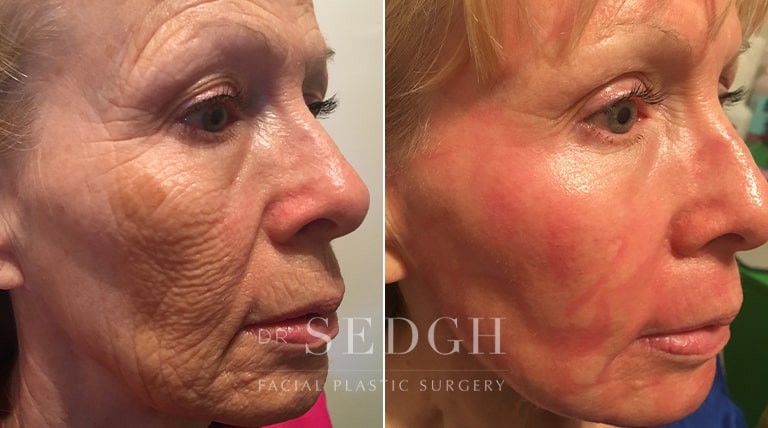 Laser Skin Treatments Before and After | Sedgh