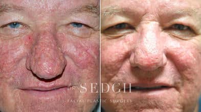 Laser Skin Treatments Before and After | Sedgh