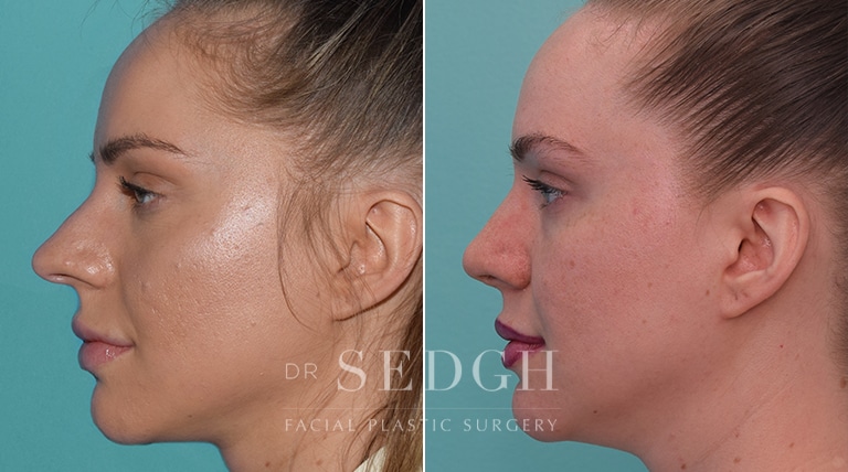 Female Rhinoplasty Before and After | Sedgh