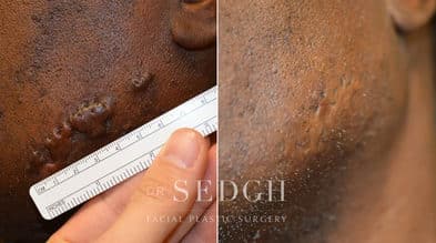 Keloid Removal Before and After | Sedgh