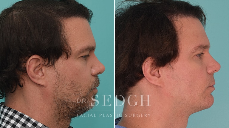 Chin Augmentation Before and After | Sedgh