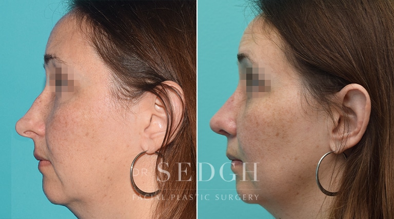 Female Rhinoplasty Before and After | Sedgh