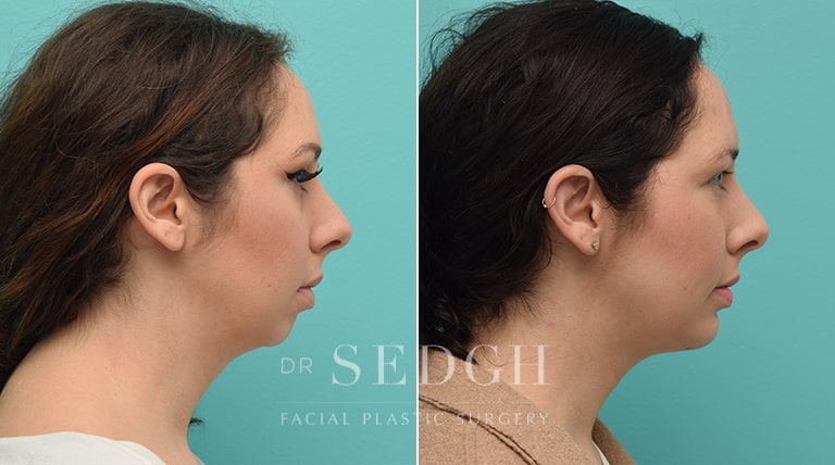 Chin Augmentation Before and After | Sedgh