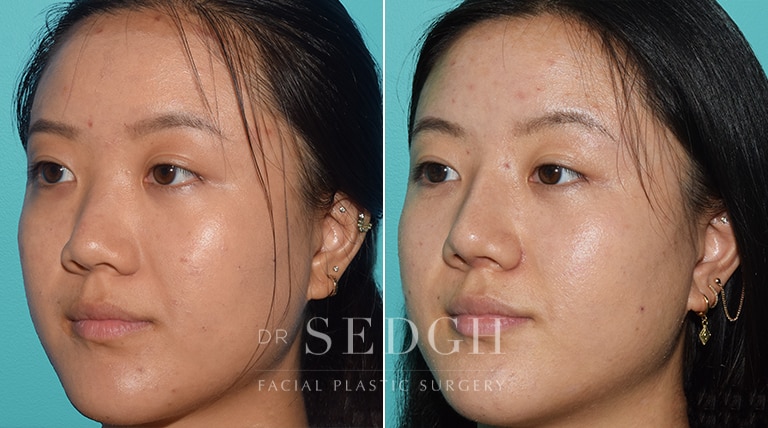 Female Rhinoplasty Before and After | Sedgh