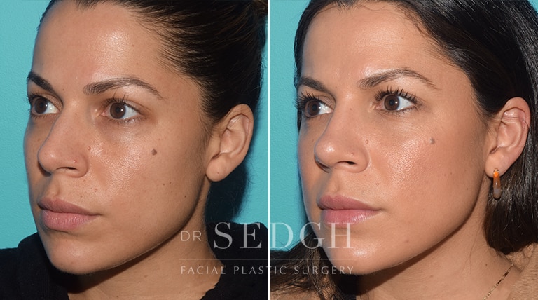 Female Rhinoplasty Before and After | Sedgh