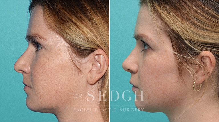 Female Rhinoplasty Before and After | Sedgh