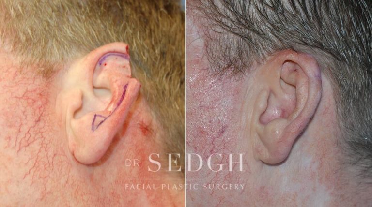 Mohs Before and After | Sedgh