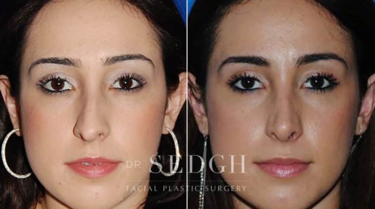 Female Rhinoplasty Before and After | Sedgh