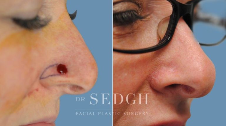Mohs Before and After | Sedgh