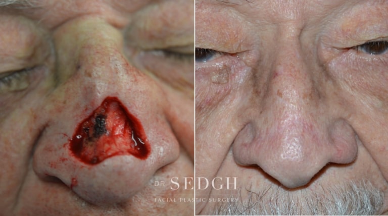 Mohs Before and After | Sedgh