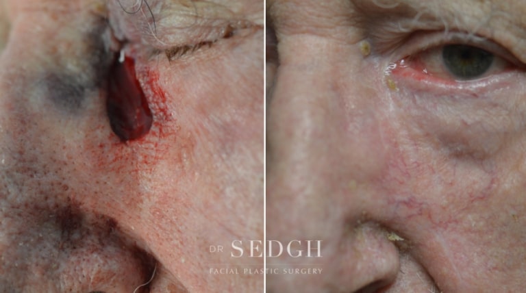 Mohs Before and After | Sedgh