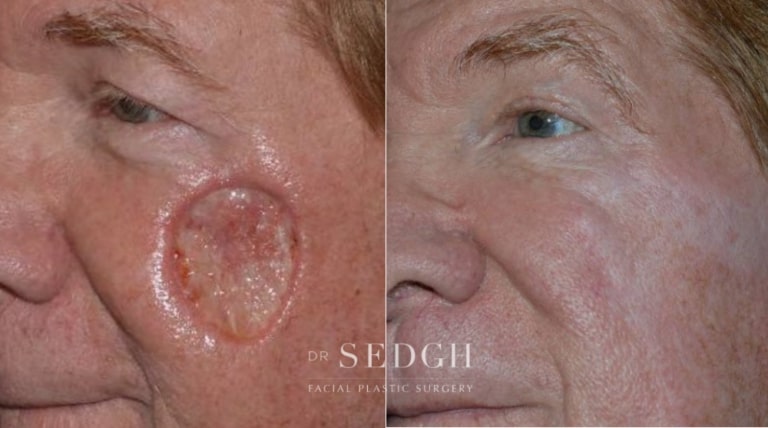 Mohs Before and After | Sedgh