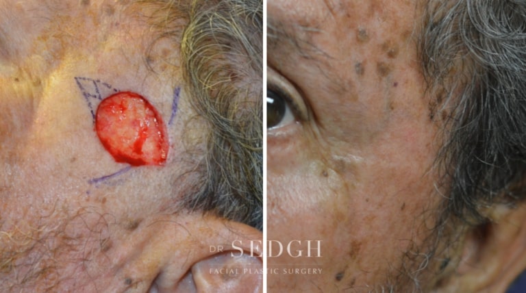 Mohs Before and After | Sedgh