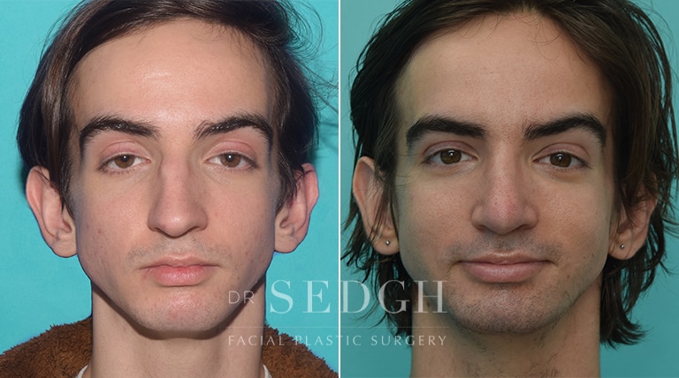 Male Rhinoplasty Before and After | Sedgh