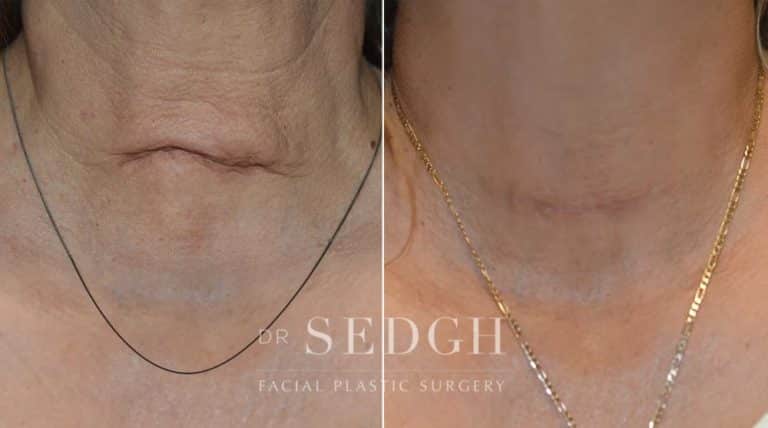 Scar Revision Before and After | Sedgh