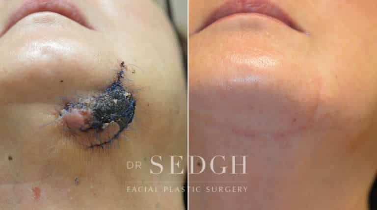 Scar Revision Before and After | Sedgh