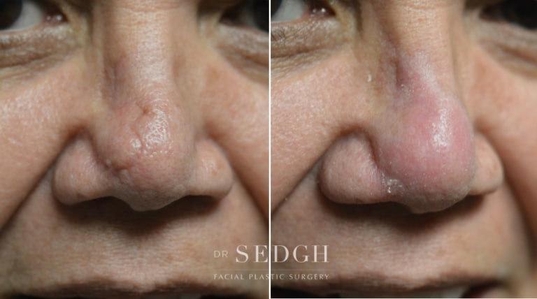 Scar Revision Before and After | Sedgh