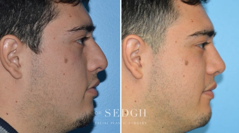 Male Rhinoplasty Before and After | Sedgh