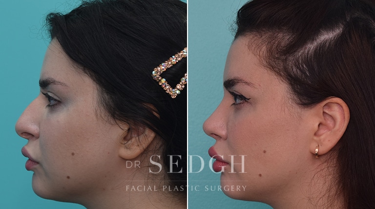 Rhinoplasty Before and After | Sedgh