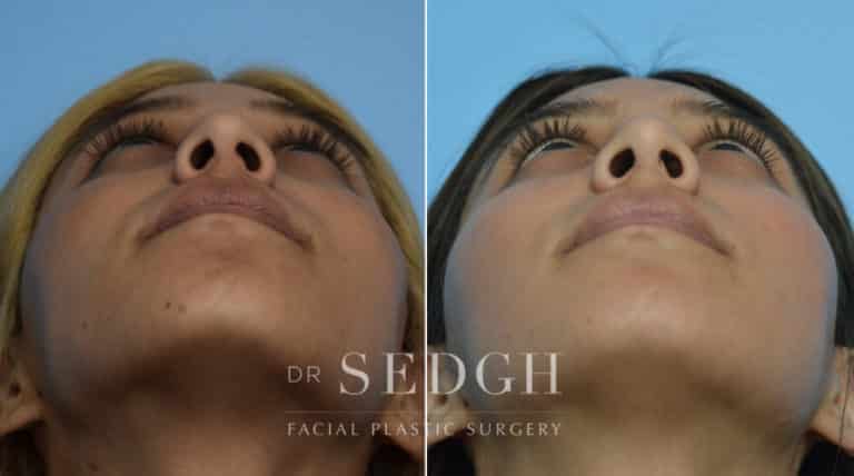 Rhinoplasty Before and After | Sedgh