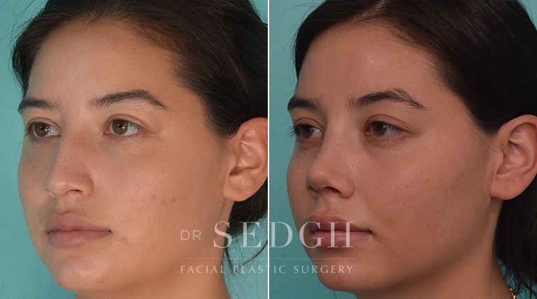 Rhinoplasty Before and After | Sedgh