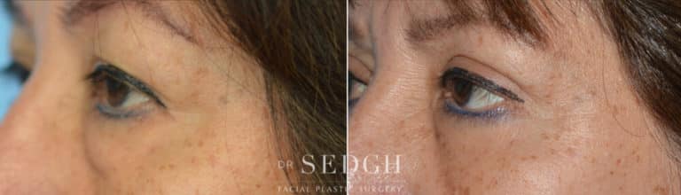 Lower Blepharoplasty Before and After | Sedgh