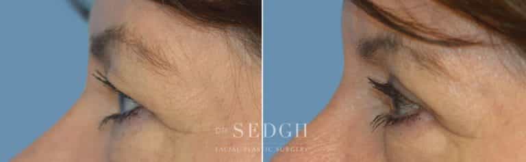 Brow Lift Before and After | Sedgh