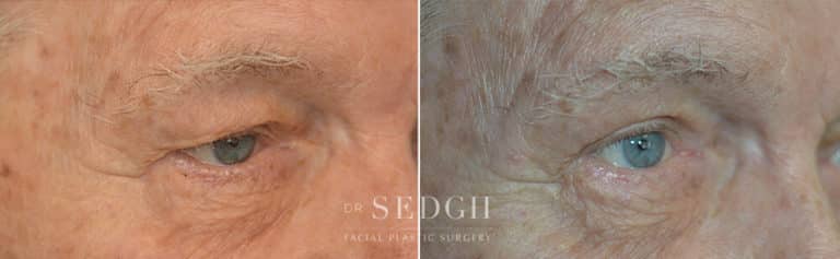 Brow Lift Before and After | Sedgh