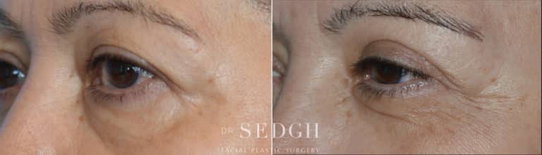 Brow Lift Before and After | Sedgh