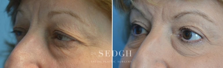 Brow Lift Before and After | Sedgh