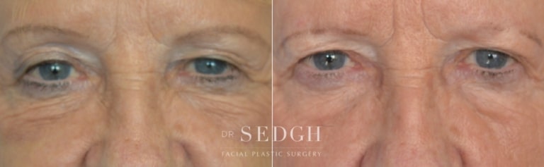 Brow Lift Before and After | Sedgh