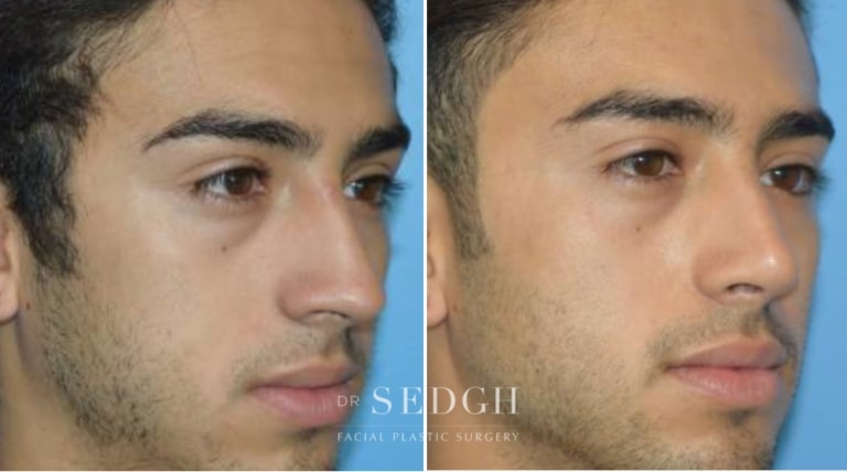 Rhinoplasty Before and After | Sedgh