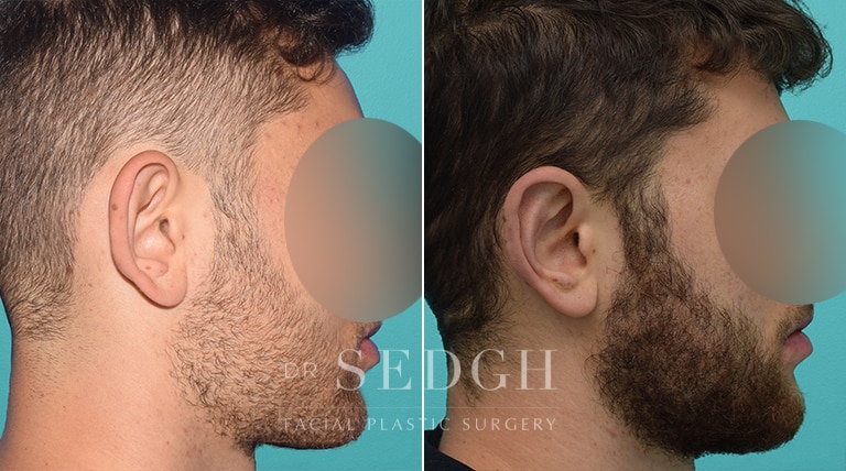 Ear Pinning Surgery Before and After | Sedgh