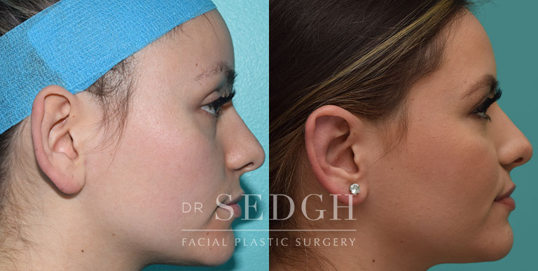 Ear Pinning Surgery Before and After | Sedgh