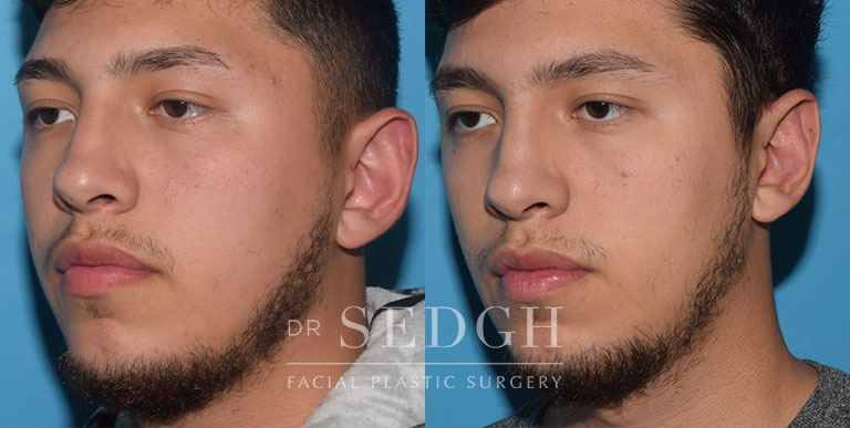 Ear Pinning Surgery Before and After | Sedgh