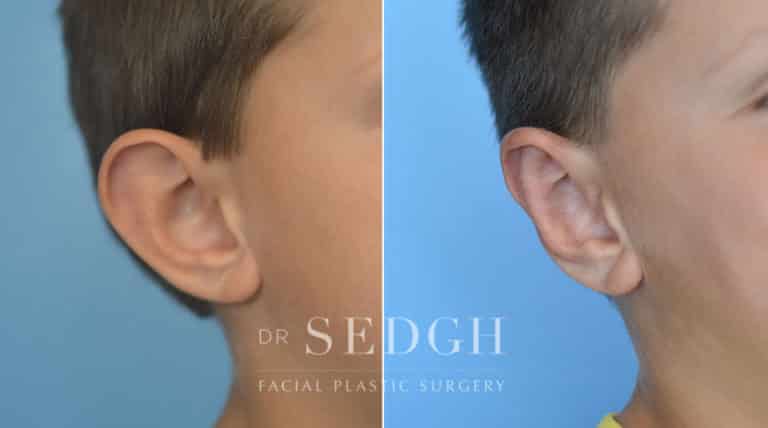 Ear Pinning Surgery Before and After | Sedgh