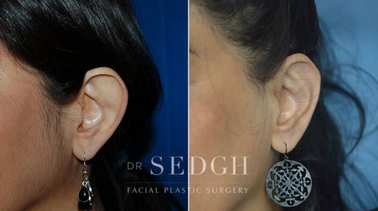 Ear Pinning Surgery Before and After | Sedgh