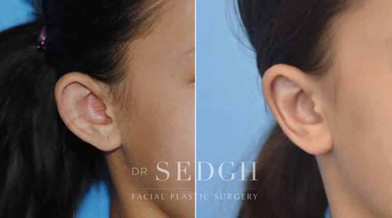 Ear Pinning Surgery Before and After | Sedgh