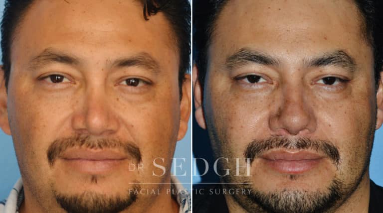 Neck Liposuction Before and After | Sedgh