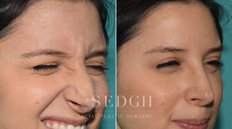 Wrinkle Relaxers Before and After | Sedgh