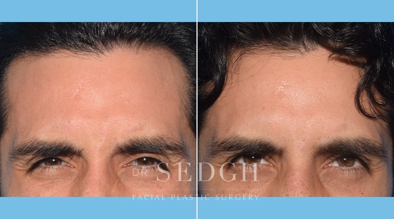 Wrinkle Relaxers Before and After | Sedgh