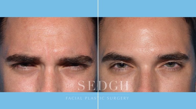 Wrinkle Relaxers Before and After | Sedgh