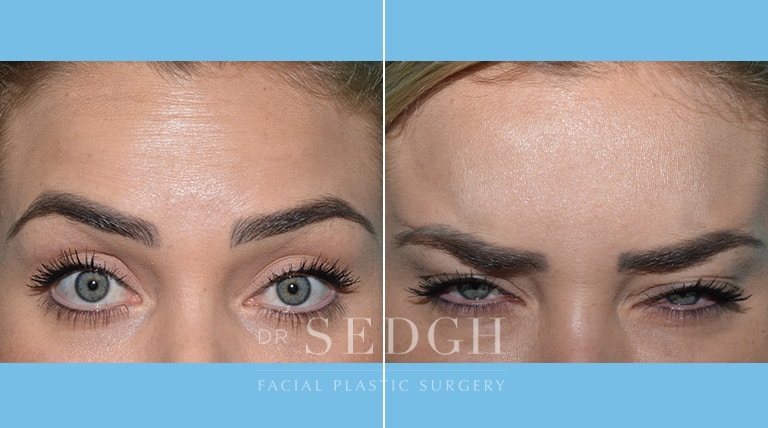 Wrinkle Relaxers Before and After | Sedgh